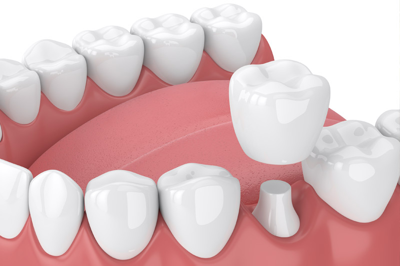 Dental Crowns in Pascagoula