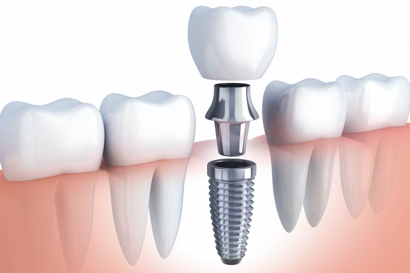 Implants Dentist in Pascagoula