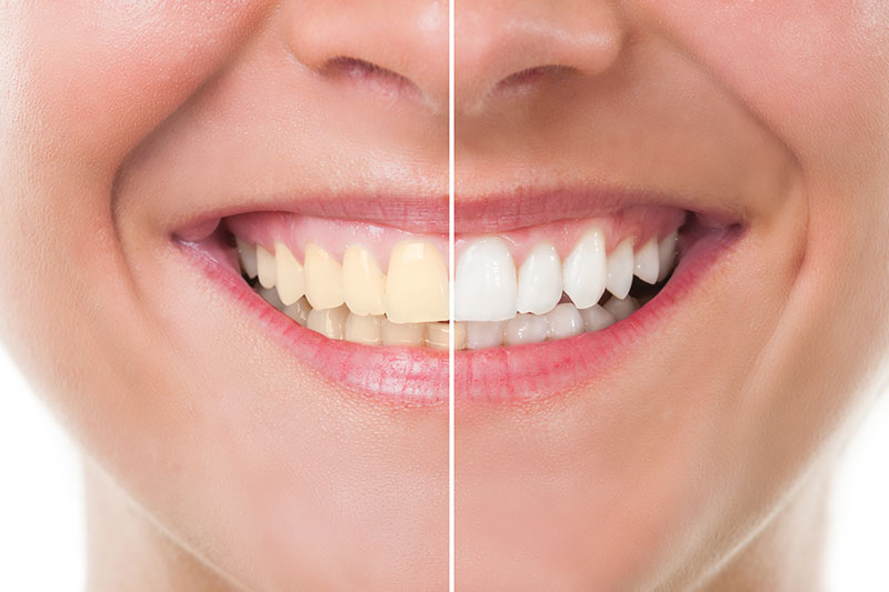 Teeth Whitening in Pascagoula